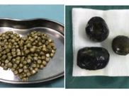 胆囊结石科普专栏