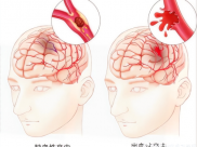 【成飞医院科普】冬季，天气冷了，又到脑卒中高发季节！