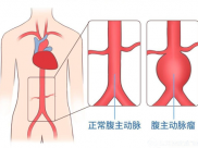【成飞医院科普】腹主动脉瘤：警惕体内的“不定时炸弹”