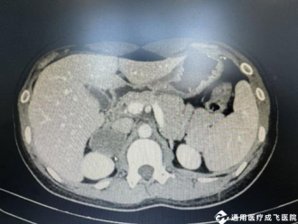 【品质医疗】体检发现“乒乓大小”肿瘤！微创手术巧拆除，成飞医院泌尿外科团队守护健康