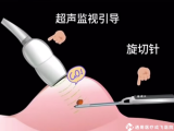 【品质医疗】“针”功夫解决乳腺结节——日间微创旋切术，微创无痕还您健康美