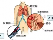 【成飞医院科普】VTE：孕产妇的隐形杀手